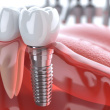 Quel est le temps de cicatrisation d’un implant dentaire ?